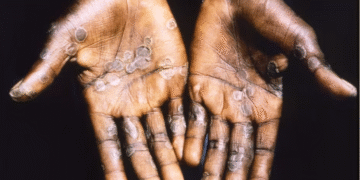 GHS confirms two Mpox cases in Accra