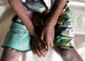 Ghana records eight mpox cases