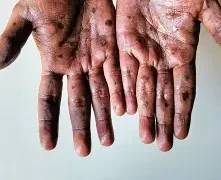 Mpox cases in Ghana rise to 133 after 14 new infections