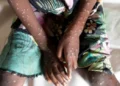 Mpox cases in Ghana rise to 79 – GHS