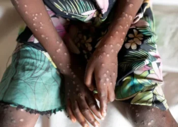 Mpox cases in Ghana rise to 79 – GHS