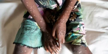 Mpox cases in Ghana rise to 79 – GHS
