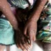 Mpox cases in Ghana rise to 79 – GHS